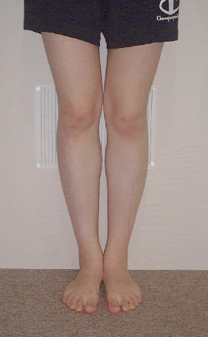 健友館きむら整体院Ｏ脚矯正後