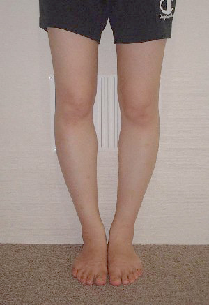 健友館きむら整体院Ｏ脚矯正